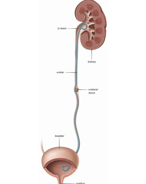 尿结石位置图片图片