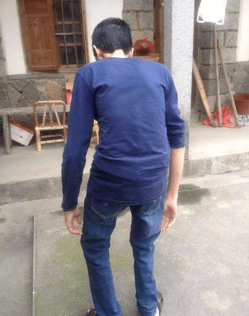 强直性脊柱炎打可善挺要打一辈子吗?