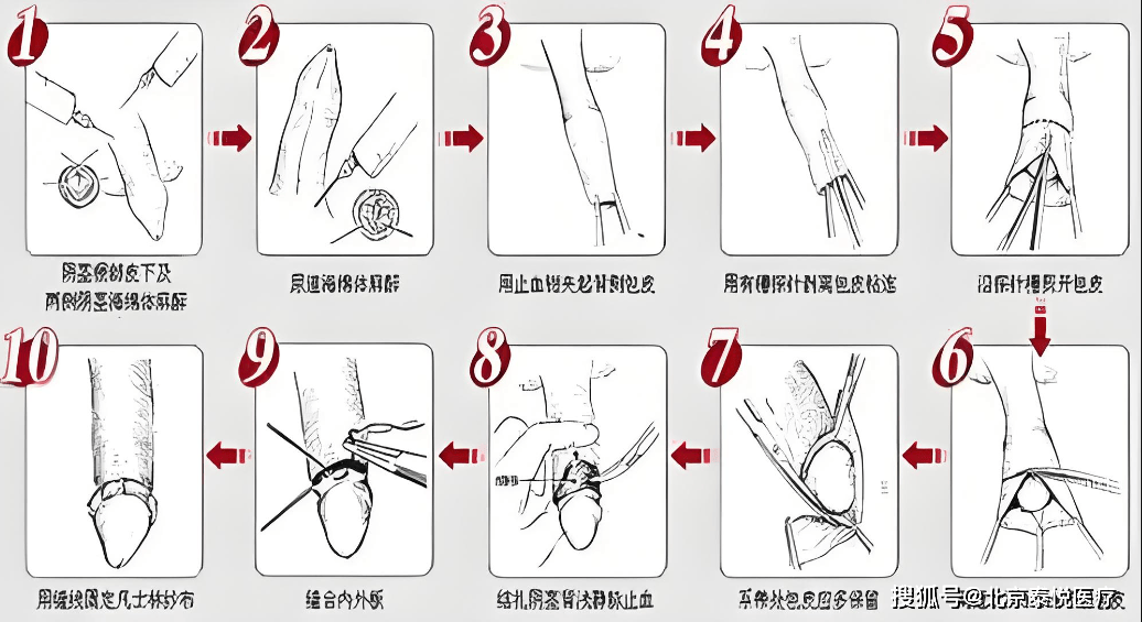 一种"隐形"的包皮手术:袖套式包皮环切术
