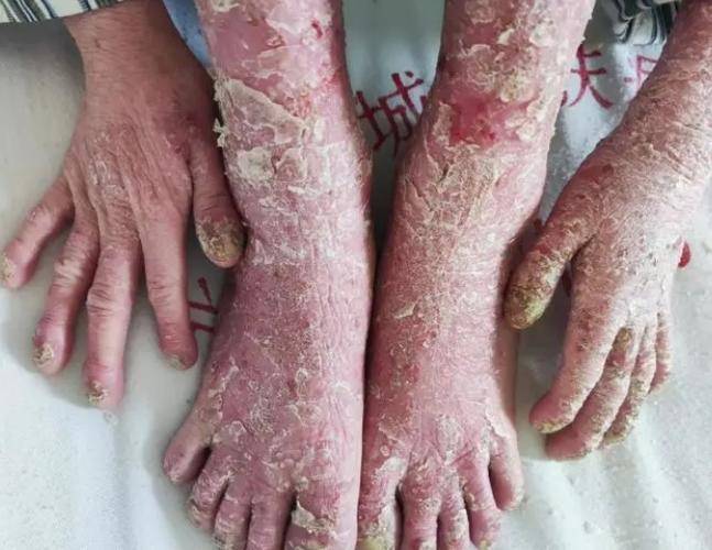 银屑病患者注意 :微循环改善,加速康复进程