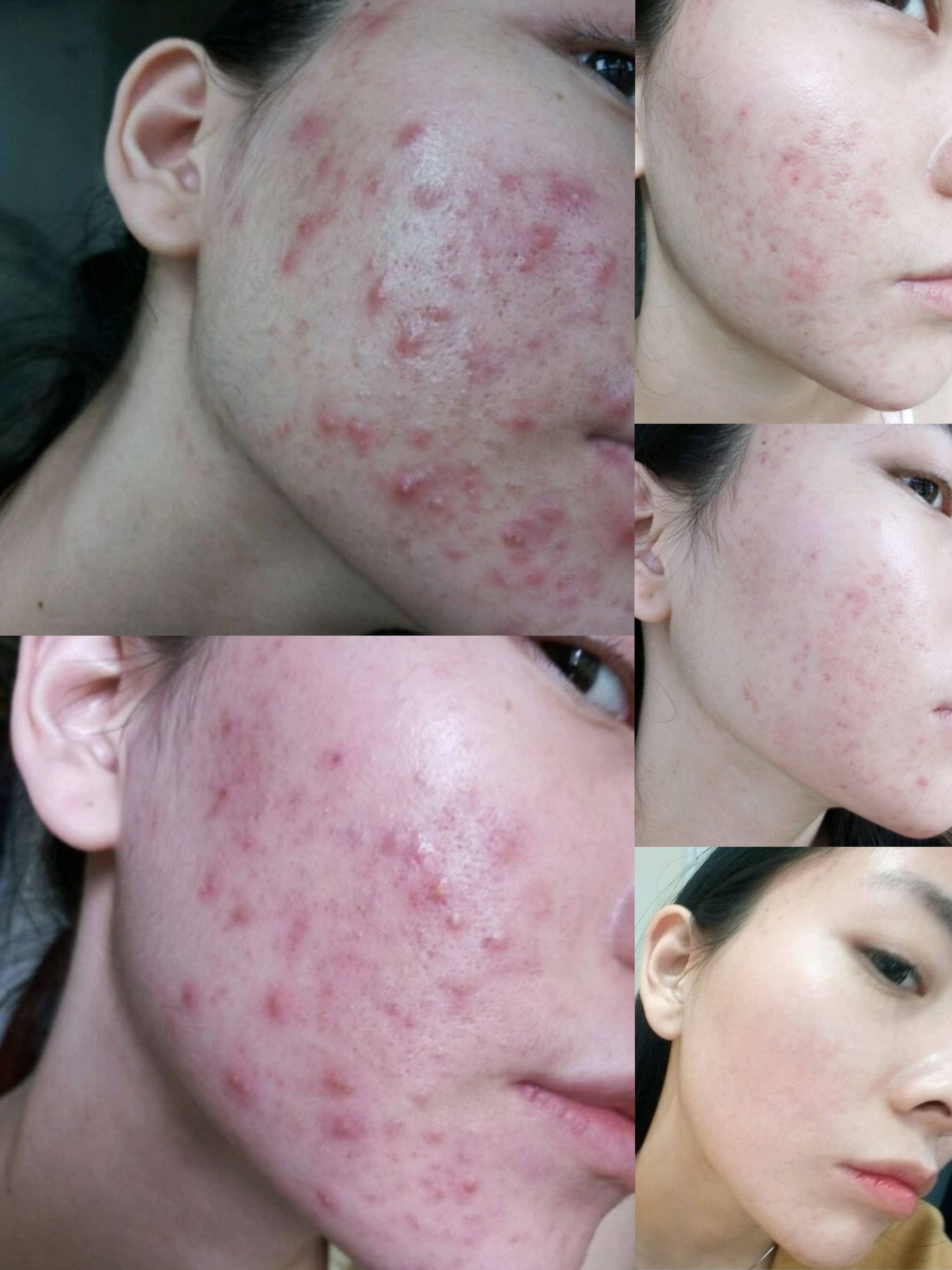 最后的照片,就是现在我素颜的样子,红色的印子已经淡了很多了,面积也