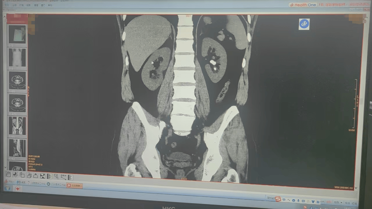 经尿道软镜右肾囊肿激光内切开引流术还有双侧输尿管支架引流术