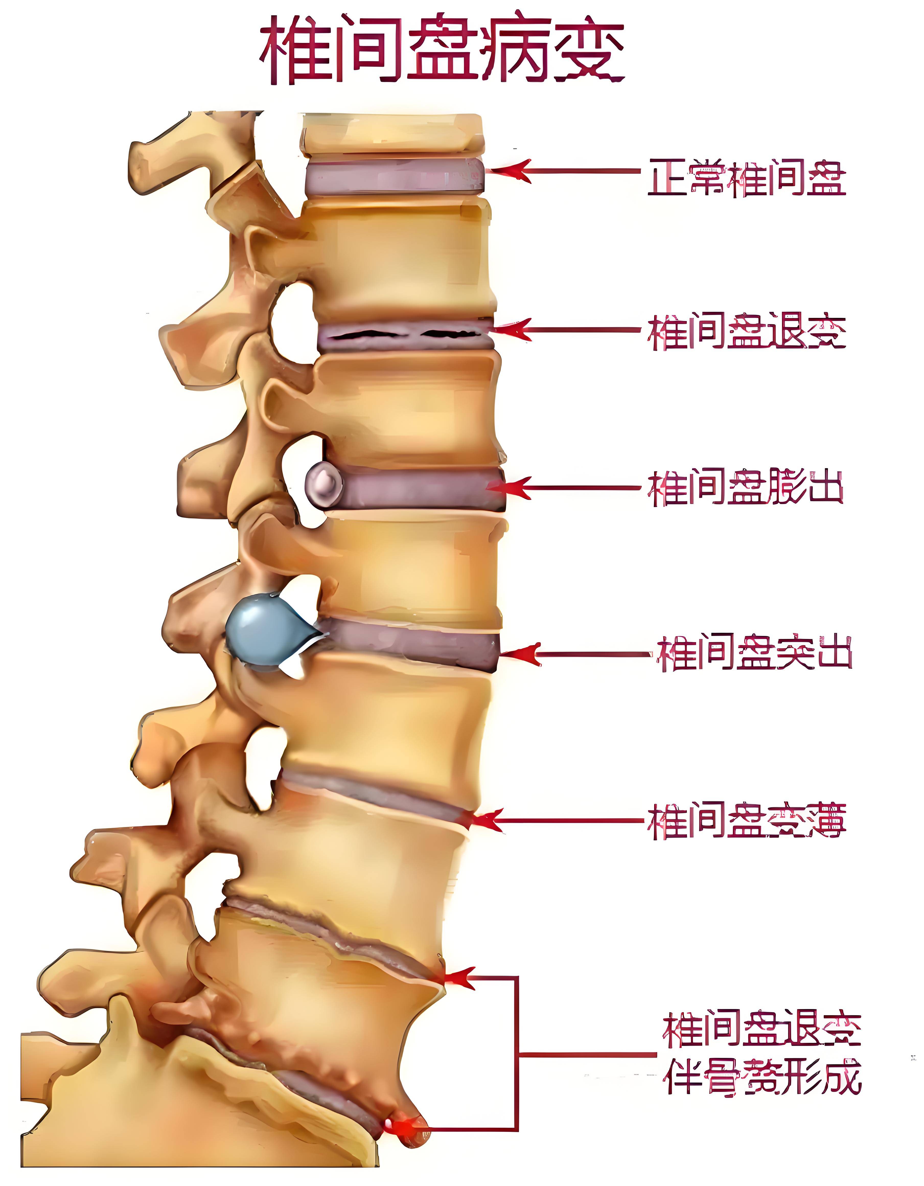 郴江医院治疗腰椎病之路