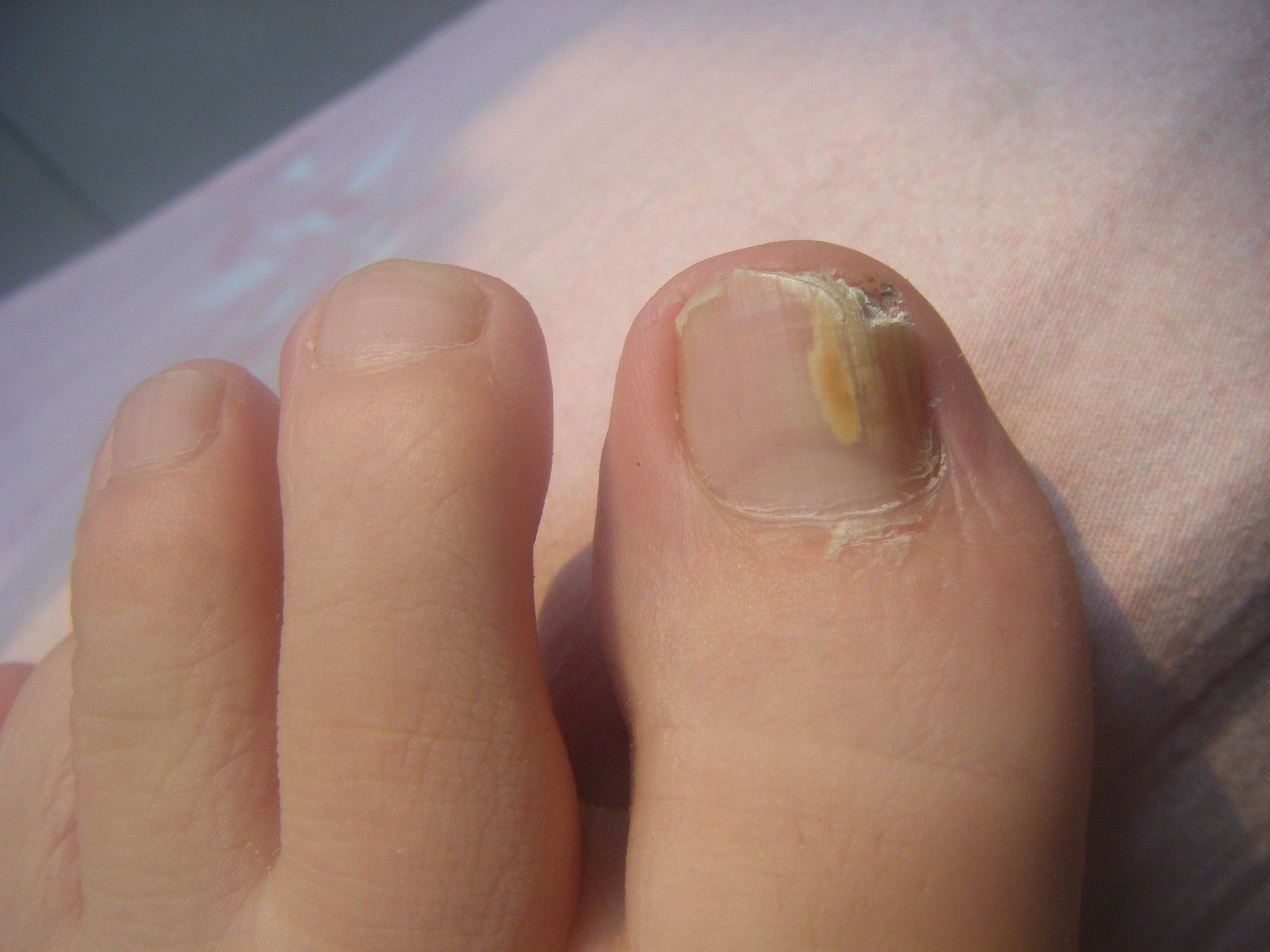 灰指甲_真菌_成分