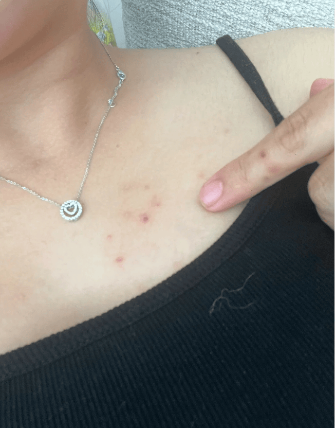 湿疹反复难缠，早治忍忍引争议，调理抉择该站哪边？