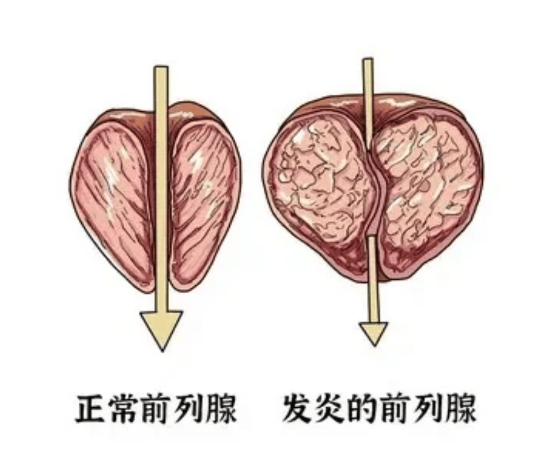 30岁以上男性前列腺问题引争议，隐患大莫轻视，选品难咋应对？