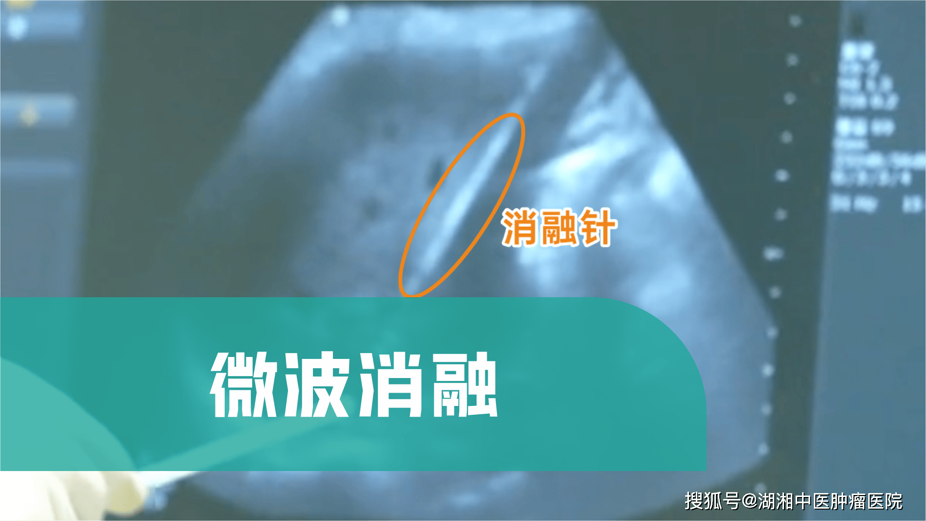 微波消融.png