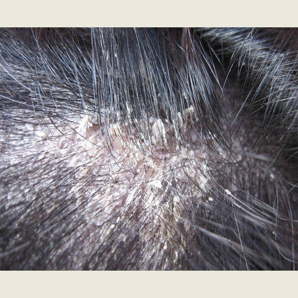 国产洗发水品牌前十名_头皮屑_成分_皮肤