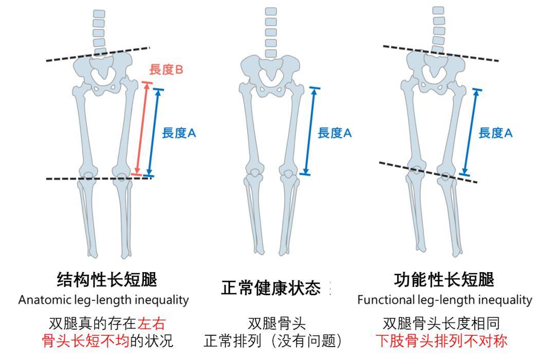 長短腿差多少cm,會引起全身性疼痛(研究)_問題_雙腳_關節