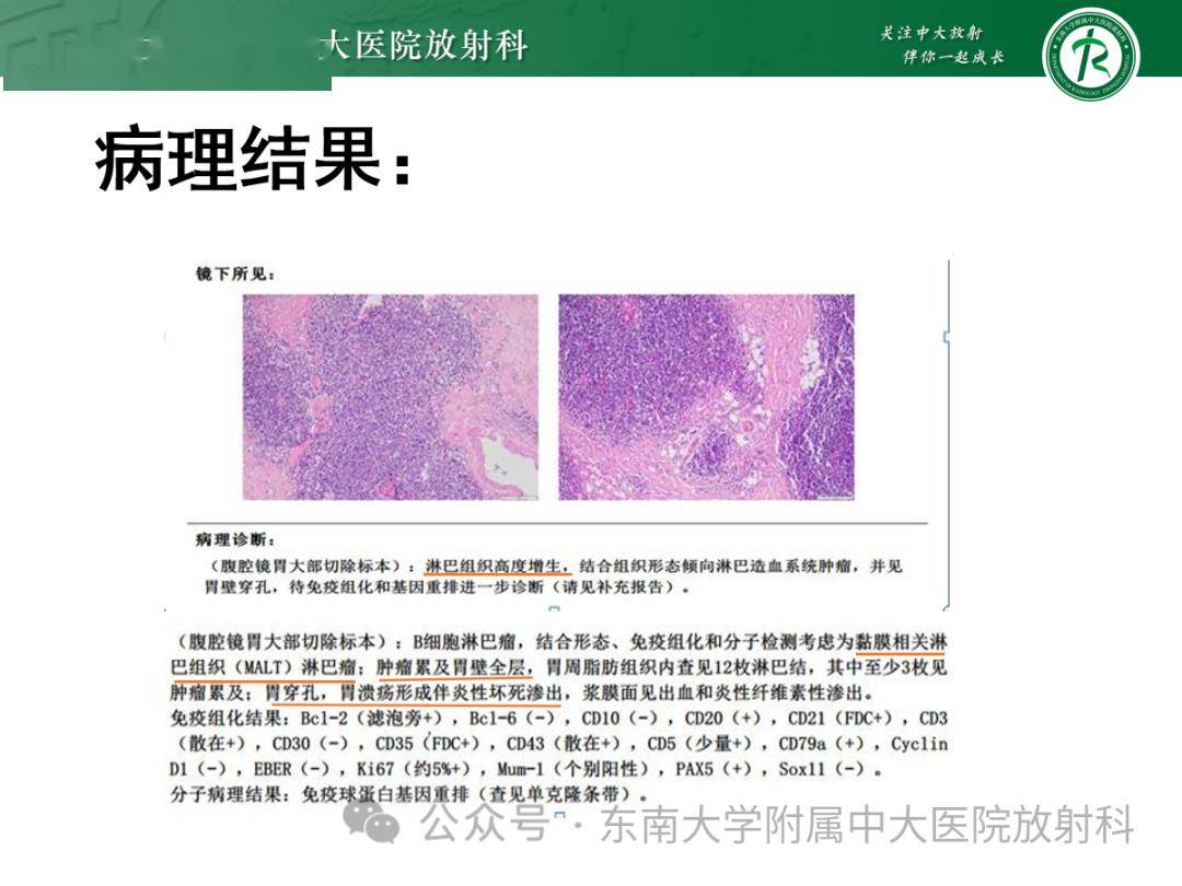 胃黏膜相關淋巴組織(malt)淋巴瘤_全網_影像_解剖圖