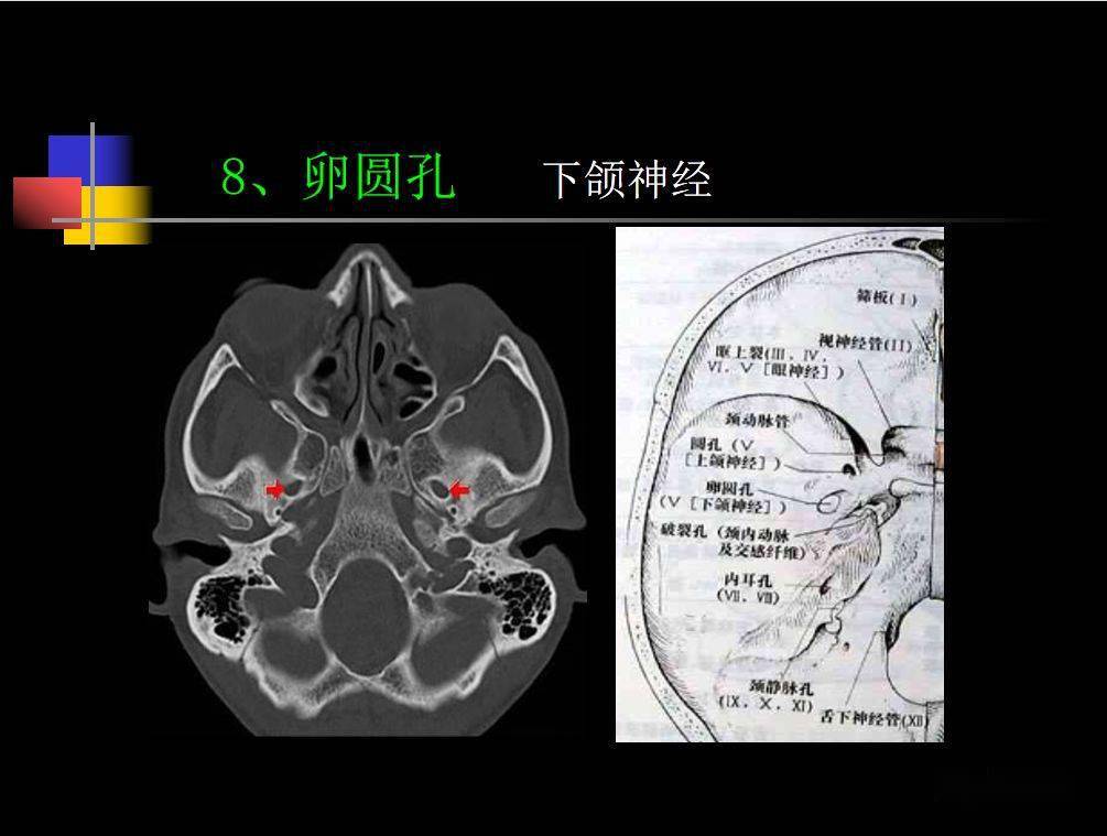 人體鼻咽部及ct的詳細解剖圖分析_全網_影像_淋巴