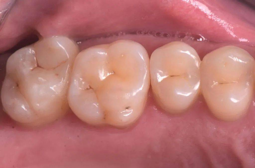 光固化垫底材料的使用时机和原因_ionosit_缝隙_牙齿