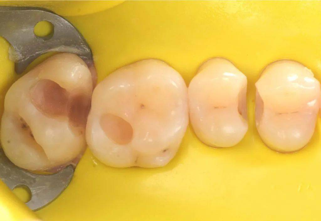 光固化垫底材料的使用时机和原因_ionosit_缝隙_牙齿