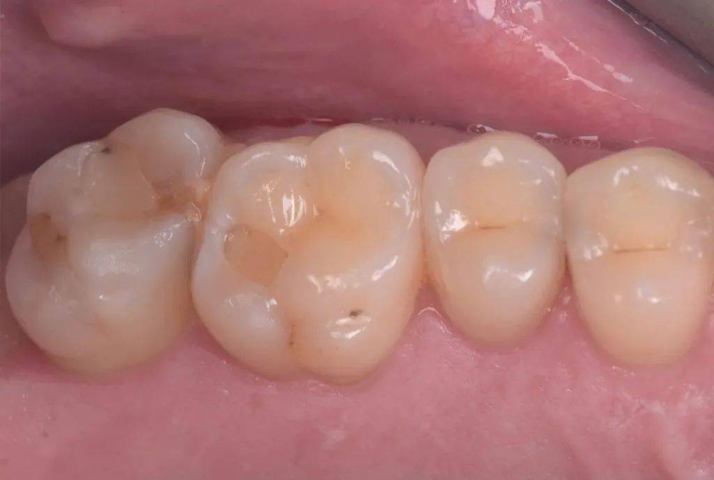 光固化垫底材料的使用时机和原因_ionosit_缝隙_牙齿