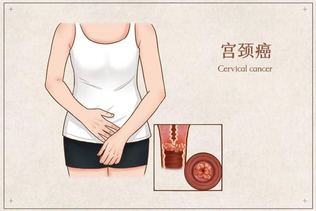 出血持續半年多…找到醫生時後悔不已_病變_檢查_宮頸