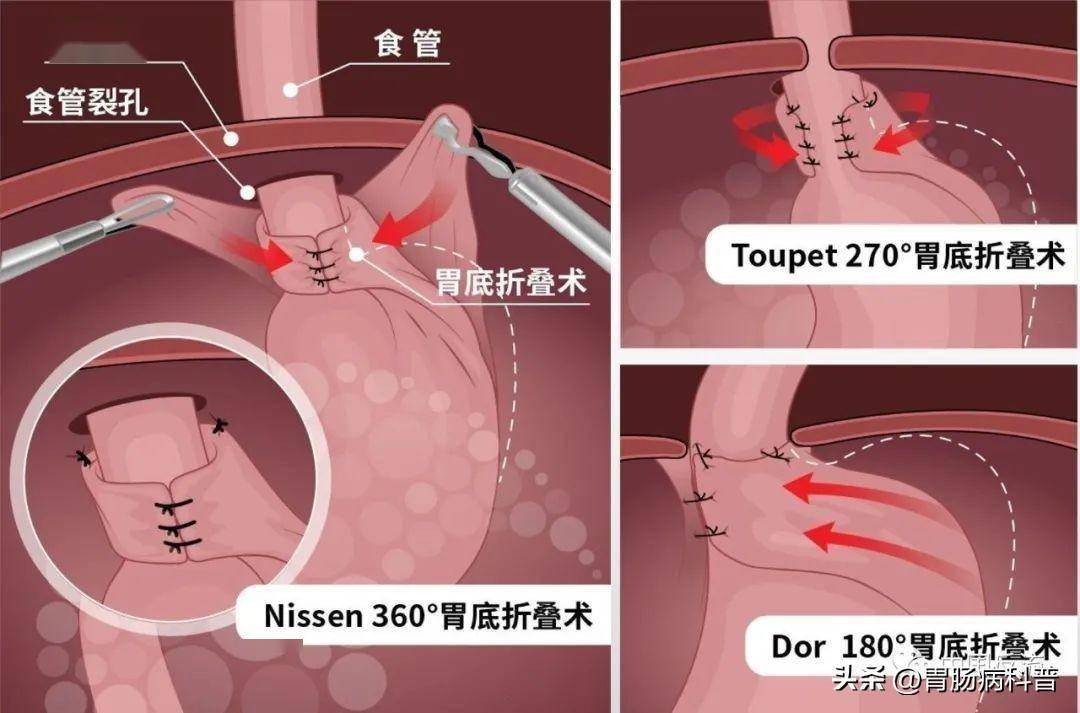 腹腔镜食管裂孔修补术 胃底折叠术是目前标准的抗反流手术,常用术式
