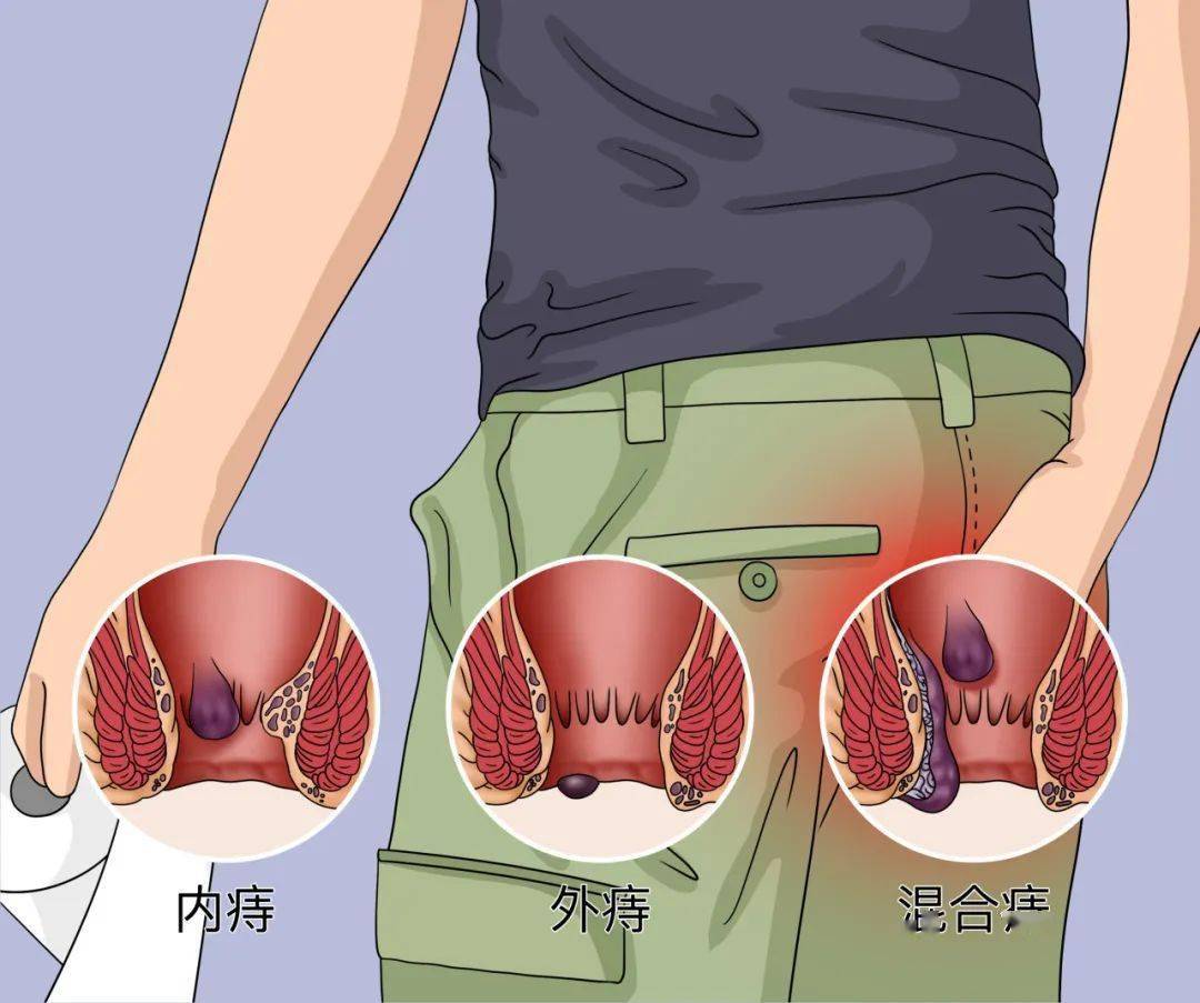 混合痔卡通图片