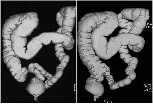 重建形成2d,3d图像,从而发现和诊断结肠病变