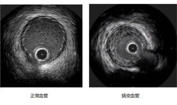 冠状动脉窦超声图像图片