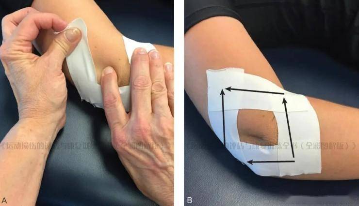 "网球肘"是什么?一篇带你学会辨别和预防!开启无痛运动!