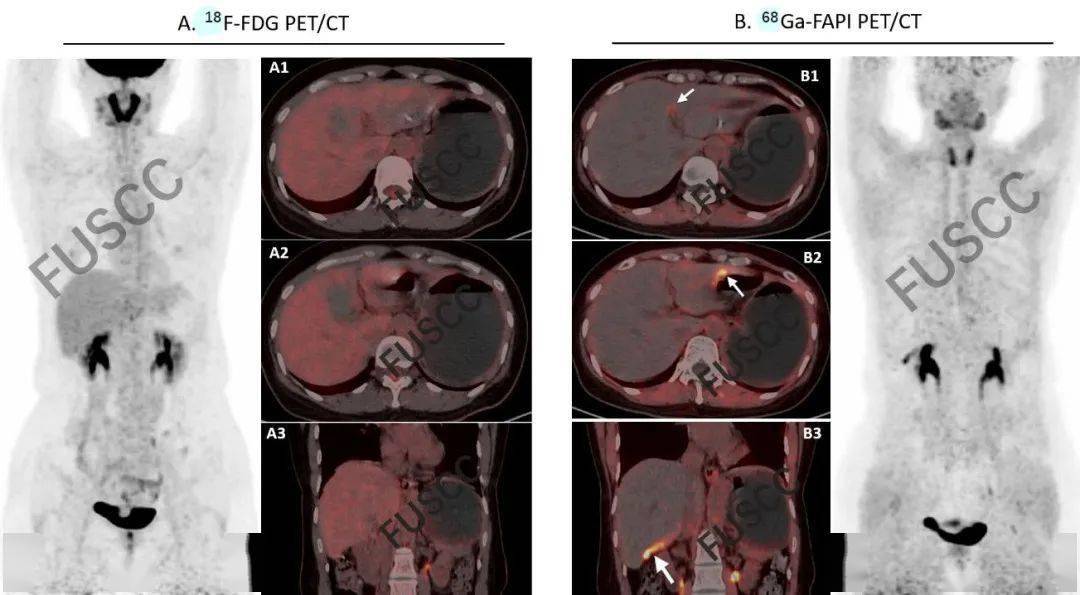 2行盆腔腫塊切除,病理為復發brca1 .術後化療6程.