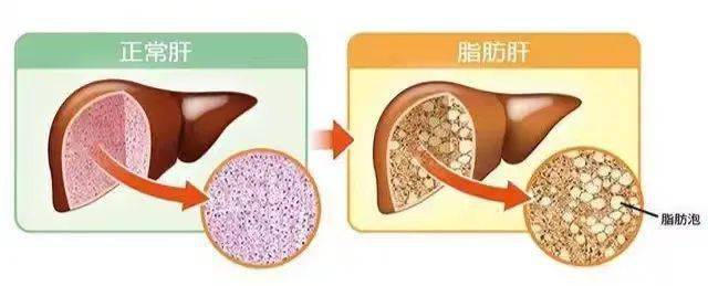 儿医·新闻丨暖心服务系列之儿童脂肪肝筛查招募行动_肝脏_检查_相关