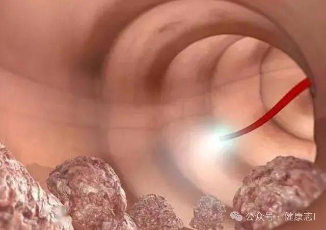 身体出现3种异常,及时做这个检查,别害羞_肠道_生活习惯_恶性肿瘤