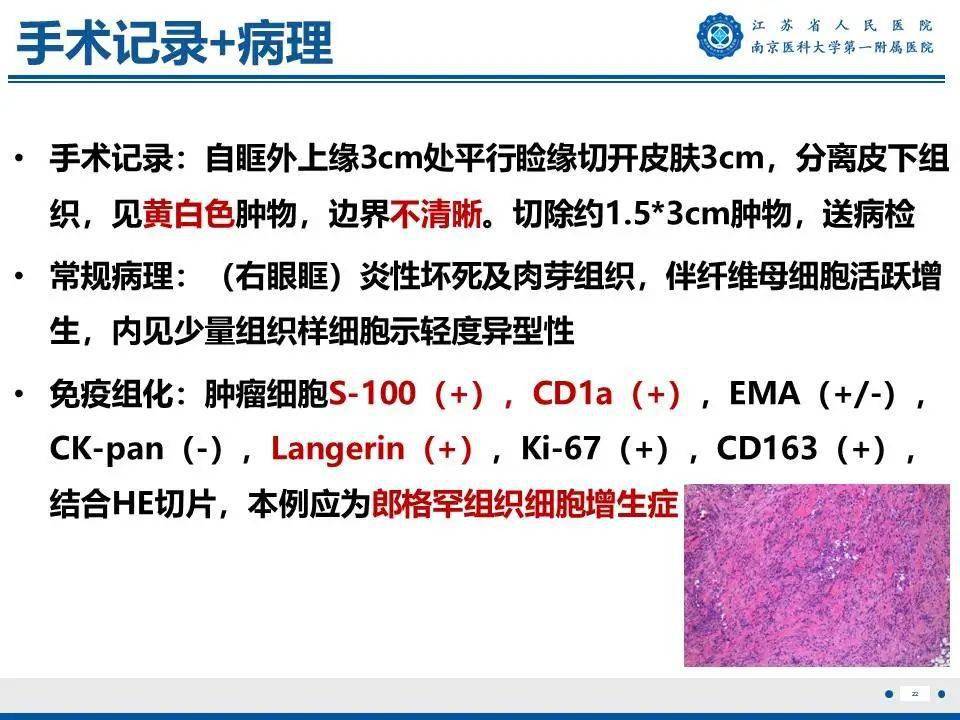 眼眶朗格漢斯細胞組織細胞增生症——破骨而出_全網