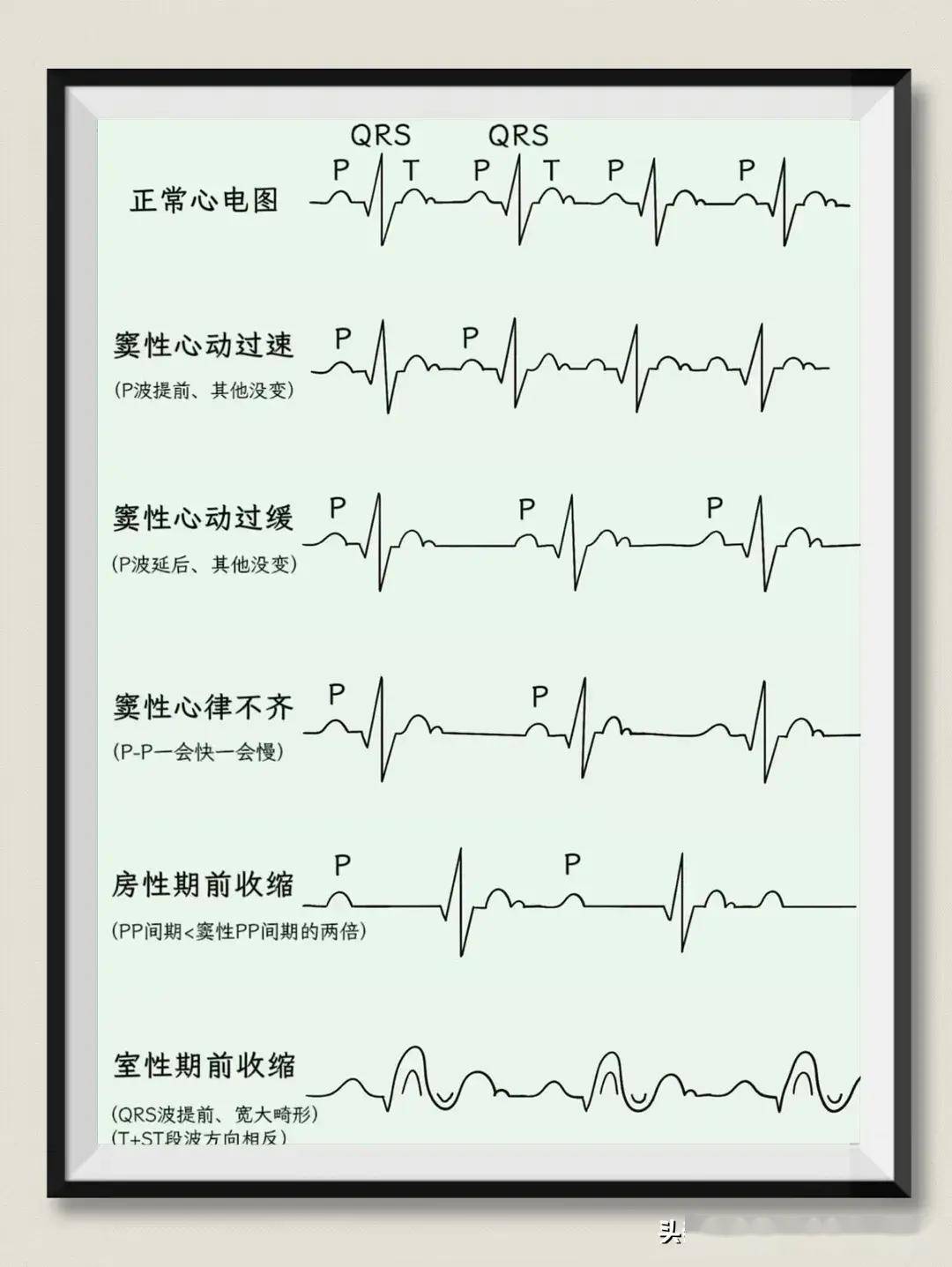 早搏的心电图表现图片