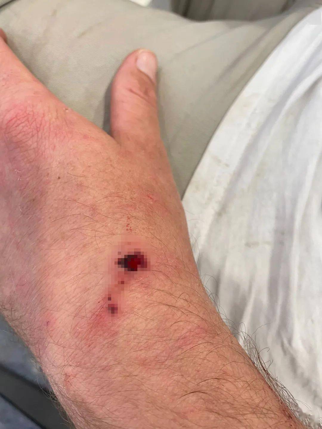 新西兰华人爆料：老公出门遭恶犬无故撕咬，鲜血淋漓！至今找不到狗和主人......