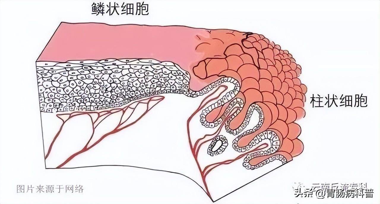 巴雷特食管症状图片图片