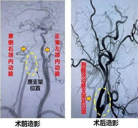 寧波二院血管外科系列科普之腦卒中防治——頸動脈術?