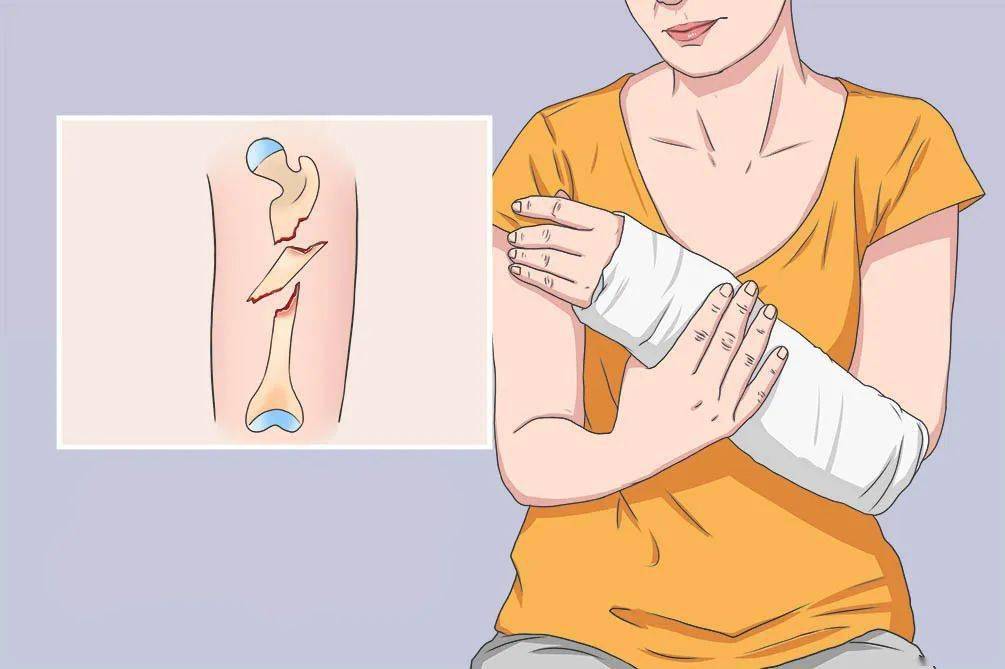 骨折后会出现不正常的活动;74骨擦音