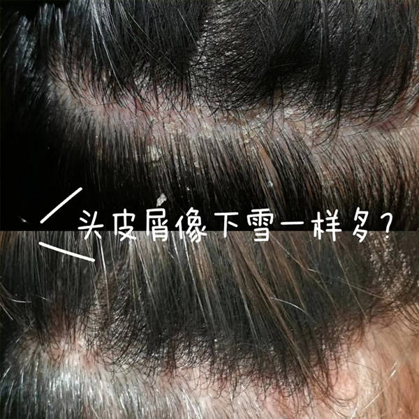 真正能去屑止癢的洗髮水?_頭髮_效果_頭皮屑