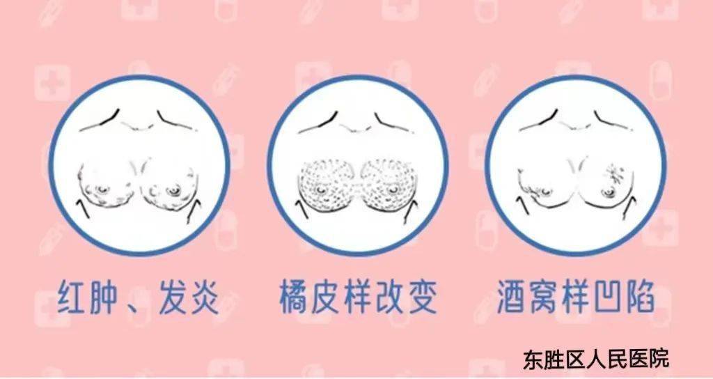 乳房酒窝症状图片图片