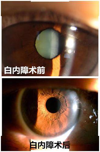发现白内障,怎么办?_手术_治疗_晶状体
