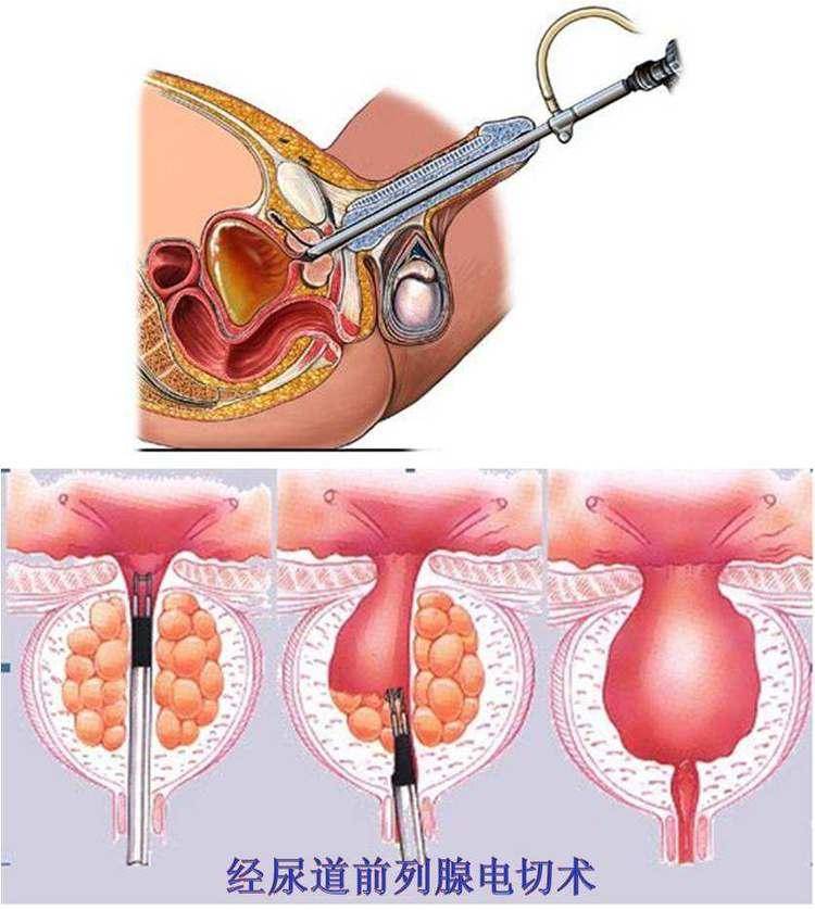 女性尿道切除术图片