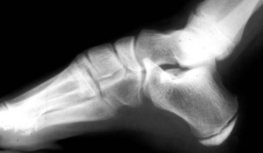 青少年足部的 x 光检查显示跟骨和足跟的放生长板