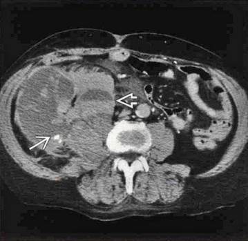 12,腹主動脈瘤疝入腰大肌及後腹膜腔,血液沿左側腰大肌延伸並通過後