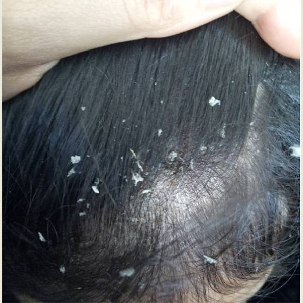 头皮屑通常源于头皮干燥,真菌感染(如头癣),或过度油脂分泌.