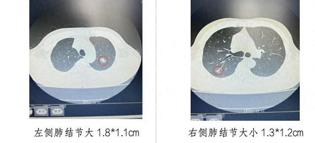 1cm,右上肺腫瘤為1.3*1.2cm,按腫瘤大小需先處理腫瘤較大一側.