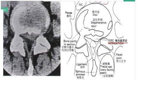 頸椎ct片,如何看?_椎間盤_錐體_關節