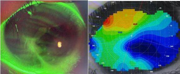 導致的角膜破裂,損傷造成的疤痕,角膜出現了明顯的不規則散光(圖1),這
