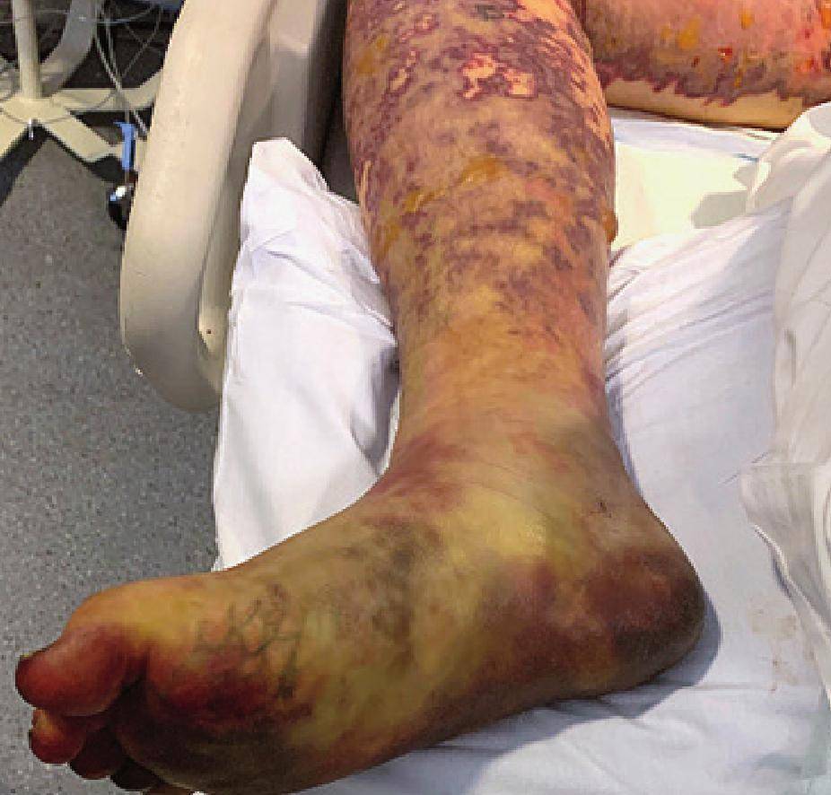 截肢后,一起吃的朋友却好好的…_患者_室友_急诊