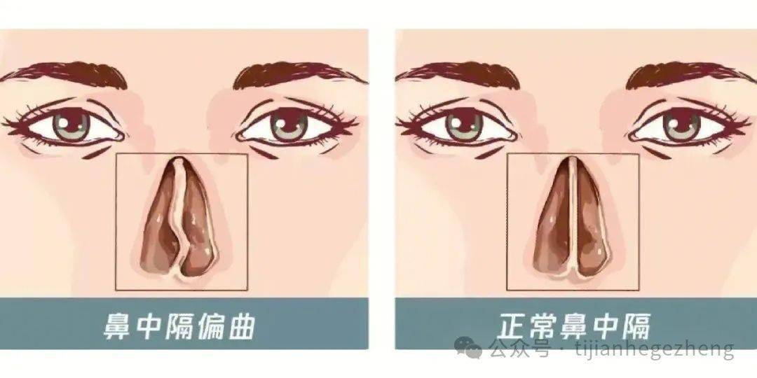 招飞体检发现鼻中隔棘突,高位偏曲可以合格吗?_鼻腔_软骨_患者