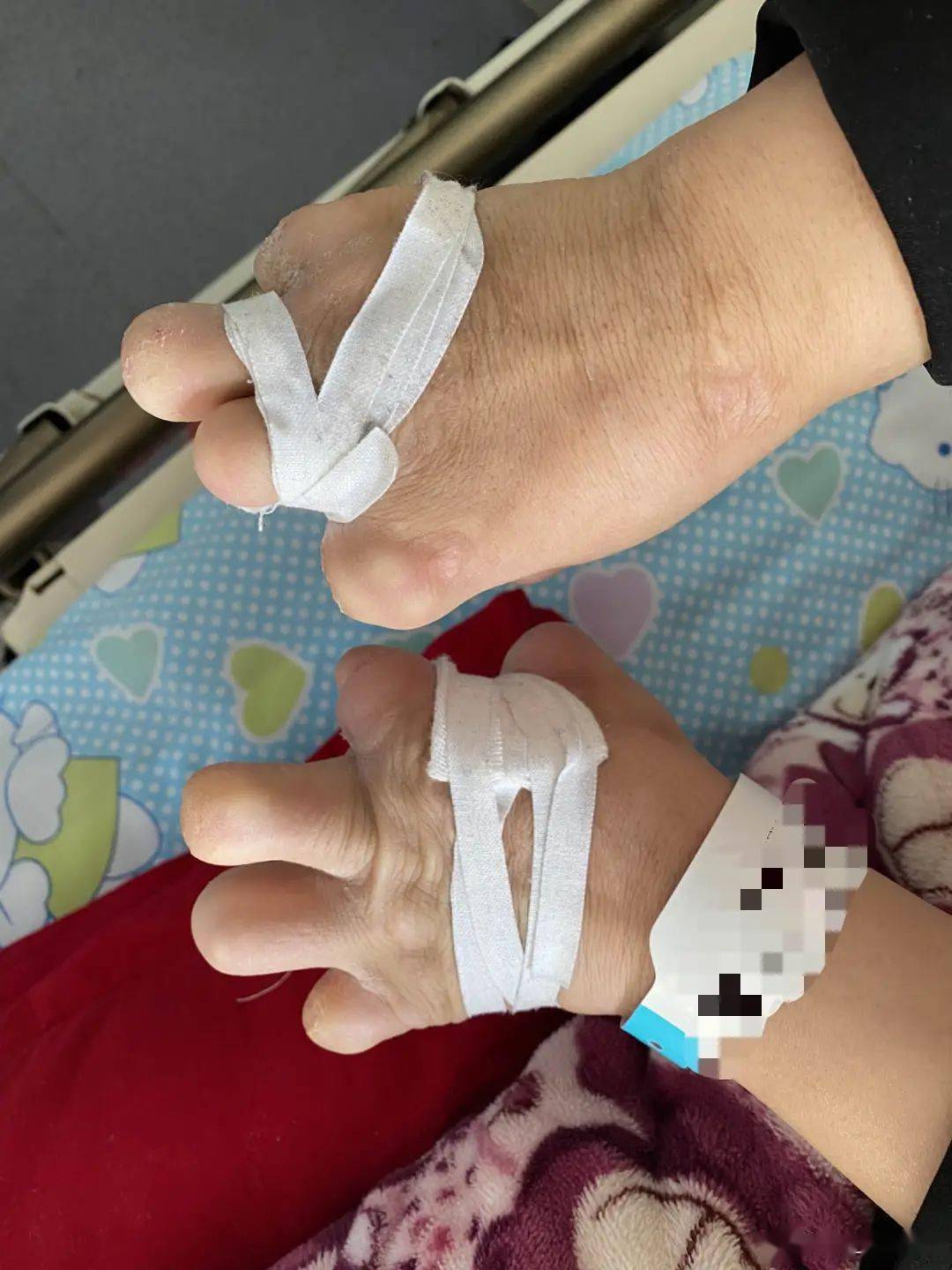 手掌情况此外,该患者四肢痛觉消失,输液打针等刺激感受不到,其它与