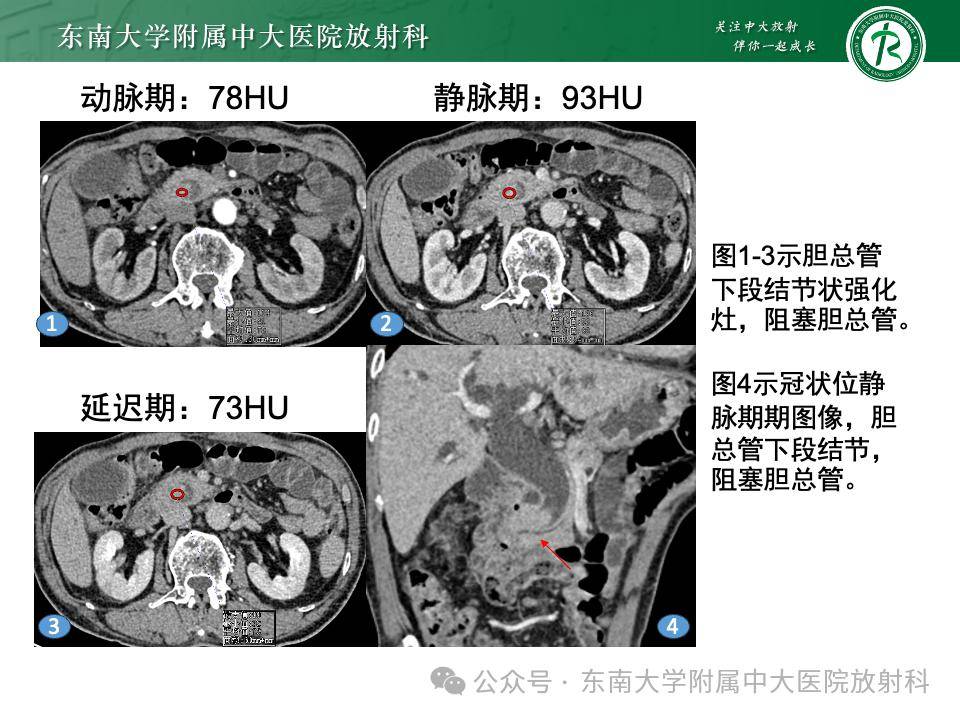 vater壶腹癌影像诊断_全网_解剖图_纳差