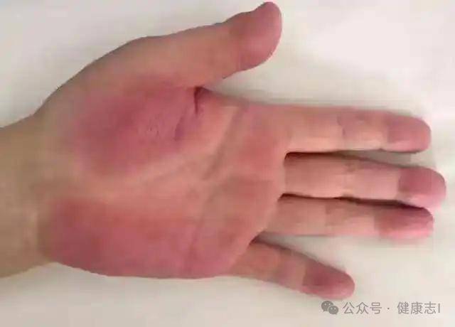 它指的就是在患者手掌的大小鱼际,指尖掌面等部位,出现了大量异常分布