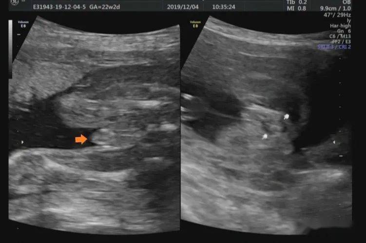 孕12周胎儿小鸡彩超图图片