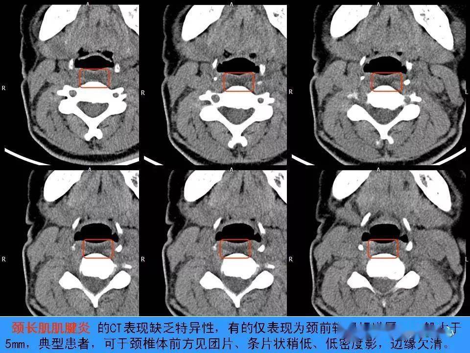 包括颈椎骨质增生,颈椎间孔狭窄,颈间盘膨隆突出等表现,综合运用dr,ct